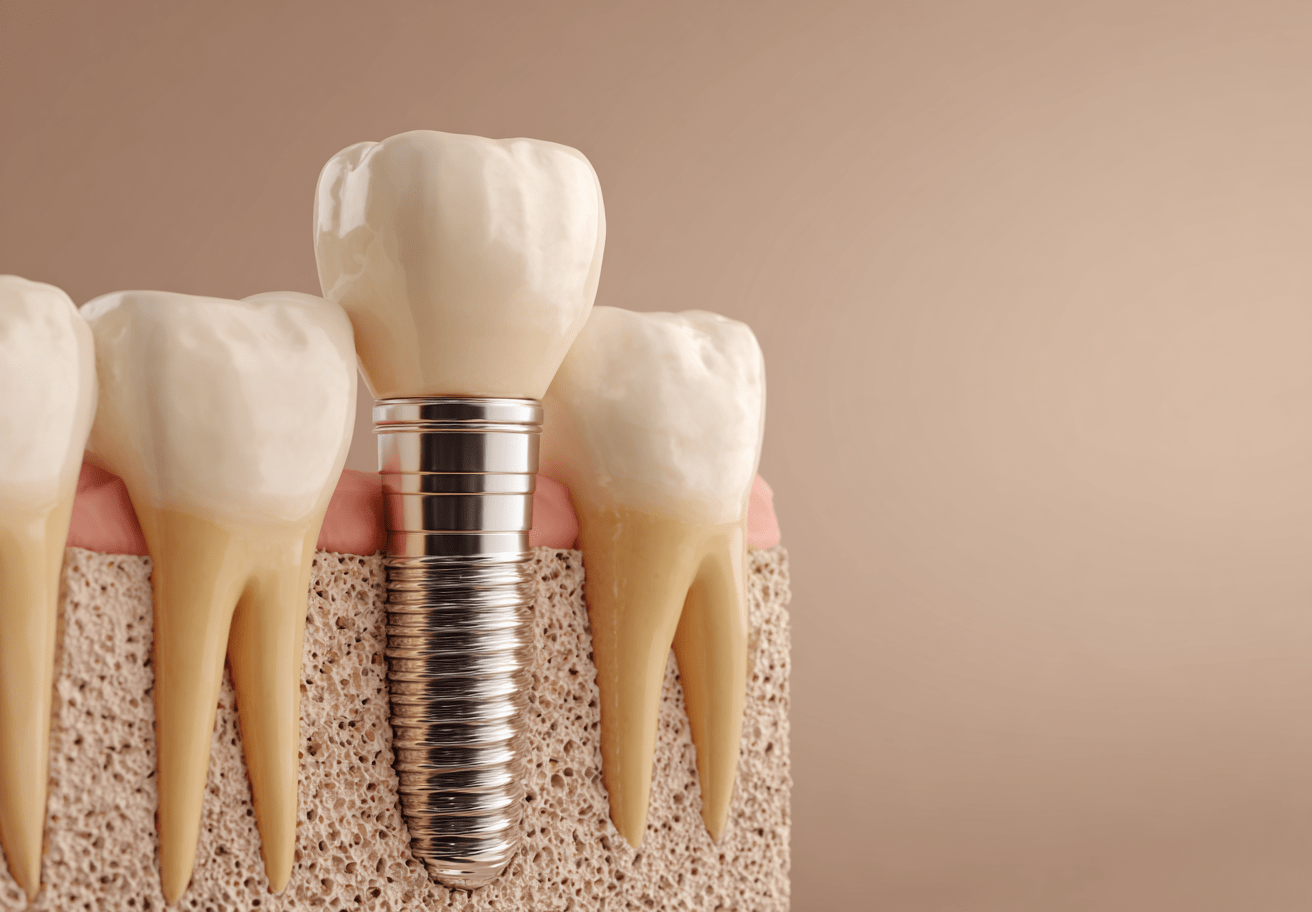 신촌역치과임플란트